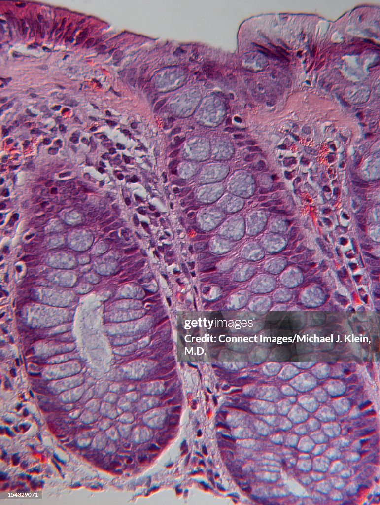 An image of collagenous colitis cells