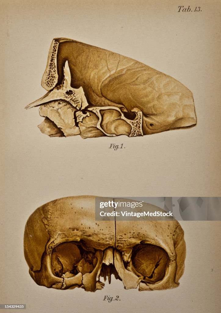 Fracture Of The Base Of The Skull By An Inlury To The Nasal Region