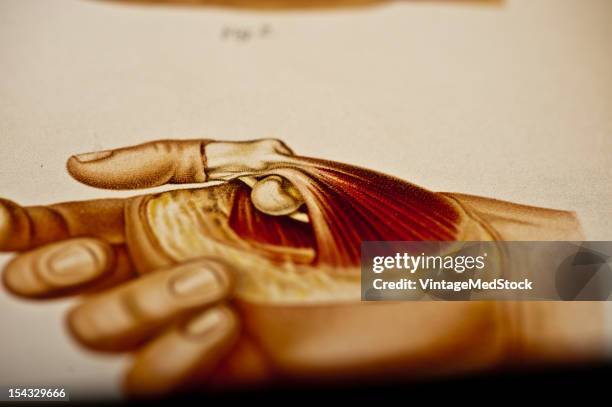 Illustration from 'Atlas and Epitome of Traumatic Fractures and Dislocations' , 1902. Fig 1 Illustrates an anatomic preparation after the artificial...