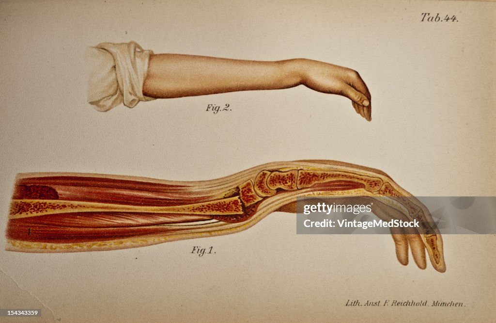 Typical Fracture Of The Lower Radial Epiphysis