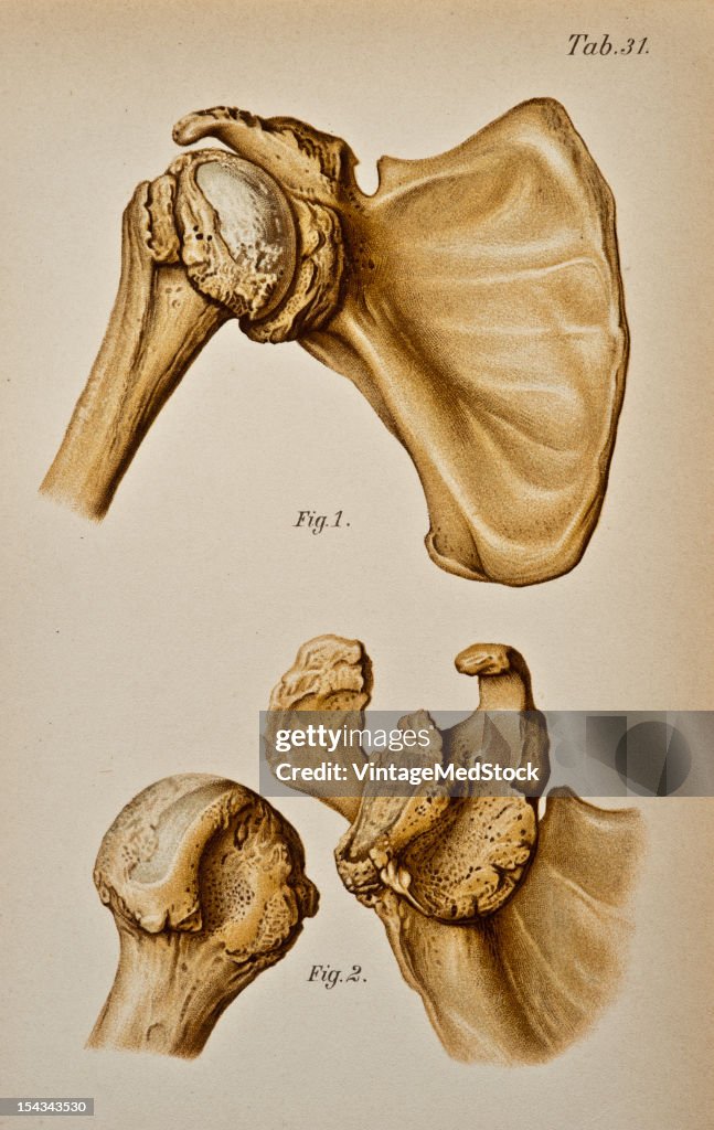 Old Subcoracoid Dislocations With The Formation Of A New Articular Surface On The Scapula And Wearing Away Of The Humerus