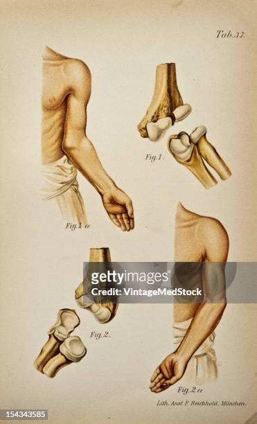 Illustration from 'Atlas and Epitome of Traumatic Fractures and Dislocations' , 1902. Fig 1 Old oblique fracture of the lower end of the humerns with...