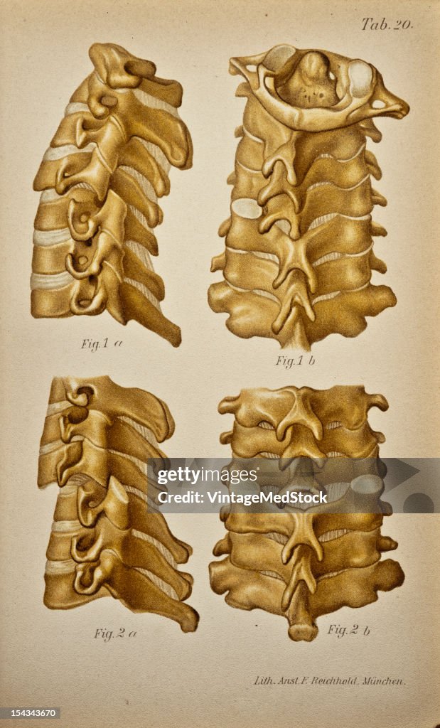 Dislocation In The Cervical Portion Of The Column