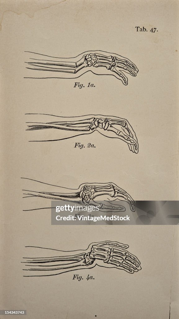 Differential Diagnosis Of Fractures And Dislocations Of The Wrist