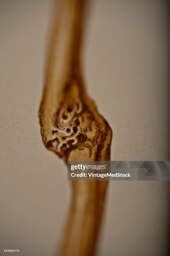 Typical Dislocation Of The Thumb