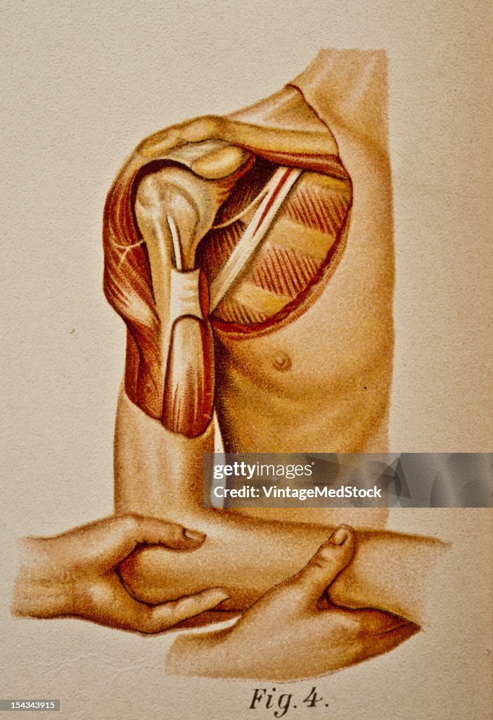 Method Of Reducing Subcoracoid Dislocation Of The Humerus