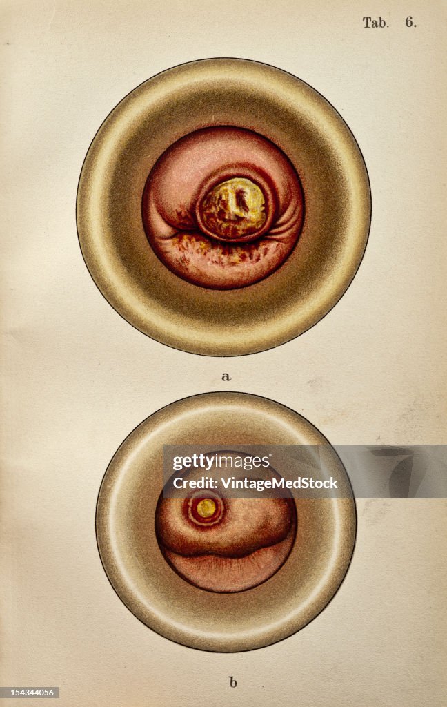 Ulcerative Sclerosis In The Vaginal Portion Of The Cervix. & Sclerosis In The Vaginal Portion Of The Cervix