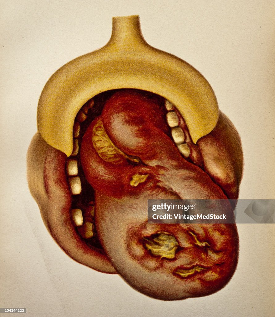 Gummatous Glossitis