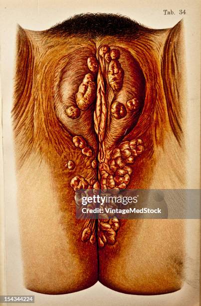 Illustration from 'Atlas of Syphilis and the Venereal Diseases' , 1898. Present Condition: At the edges of the labia majora on the perineum and about...