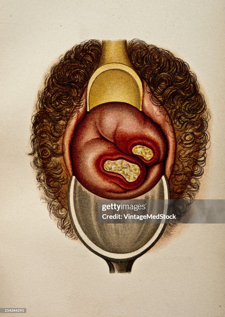 Two Ulcerative Scleroses On The Os Uteri
