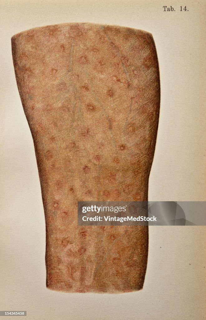 Large Macules Mixed With Papules, Scattered Over Entire Body