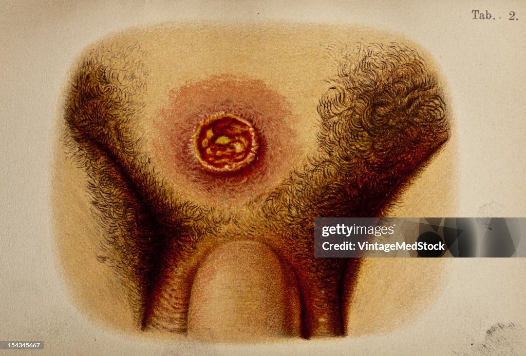 Sclerosis In The Pubic Region