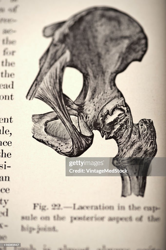 Fracture Of The Skullcap Continued To The Base