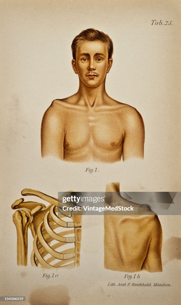 Upward Dislocation Of The Acromial End Of The Clavicle