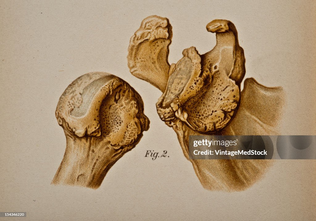 Old Subcoracoid Dislocations With The Formation Of A New Articular Surface On The Scapula And Wearing Away Of The Humerus