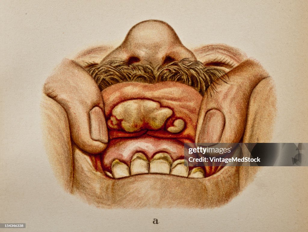 Infiltration And Superficial Necrosis Of The Mucosa And Submucosa Of The Upper Lip