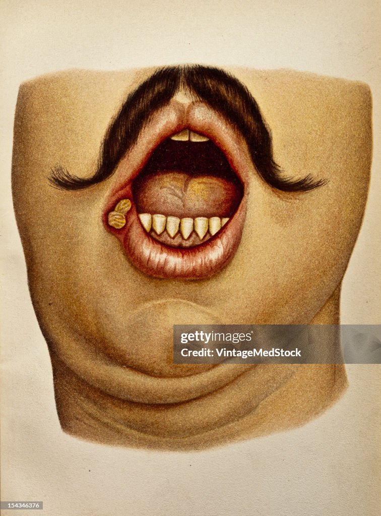 Sclerosis At The Right Angle At The Mouth