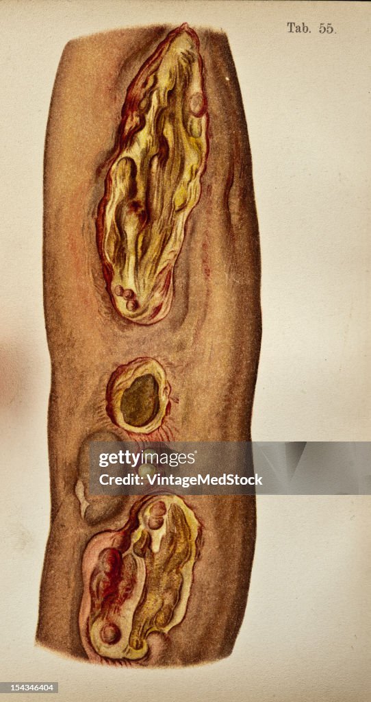 Gummatous Disease And Necrosis Of The Soft Parts