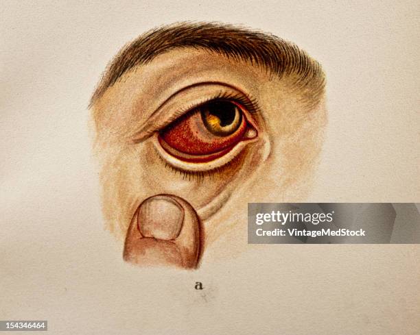 Illustration from 'Atlas of Syphilis and the Venereal Diseases' , 1898. Present Condition: Ciliary congestion of the right eye. Cornea and aqueous...