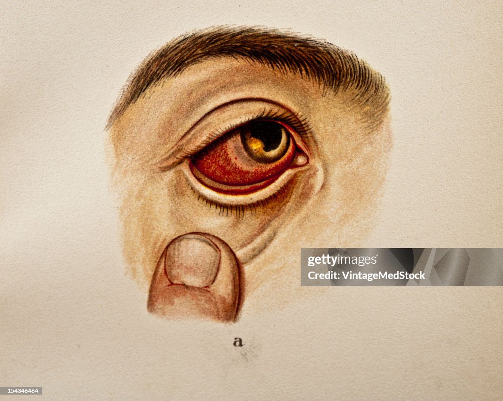 Condylomatous Iritis
