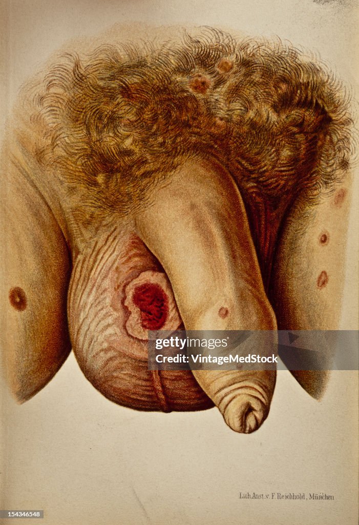 Sclerosis On The Anterior Surface Of The Scrotum