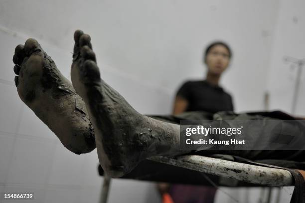 The feet of a Buddhist Rakhine victim in Kyauk Taw township hospital on October 25, 2012 in Kyauk Taw, Myanmar. Over twenty thousand people have been...