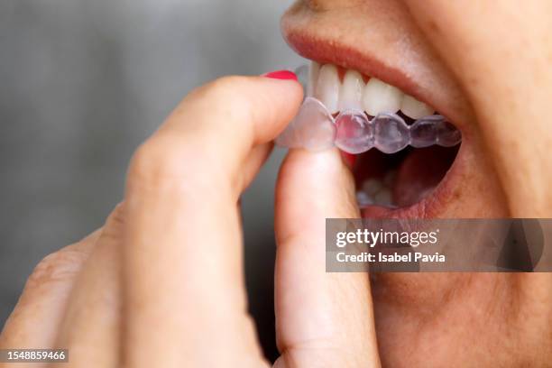 close-up of young woman wearing clear invisible orthodontics - apparecchio ortodontico foto e immagini stock