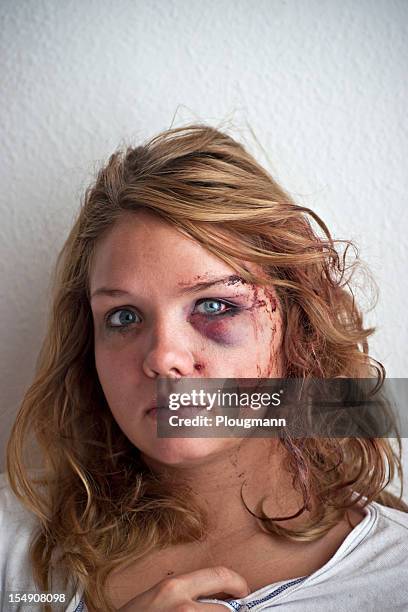 jovem mulher com olhos de lesões - head wound - fotografias e filmes do acervo