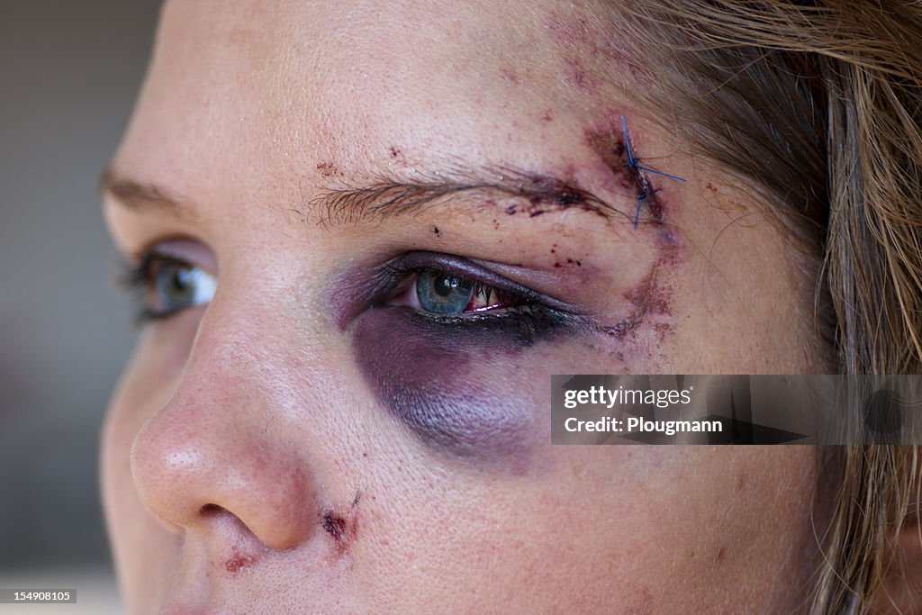 Young woman with eye injury - close up