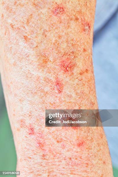 actinic keratosis skin cancer - mottled skin 個照片及圖片檔