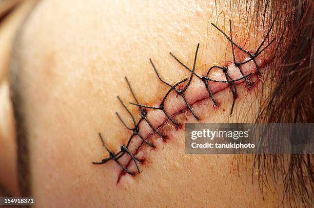 puntos primer plano - suture fotografías e imágenes de stock