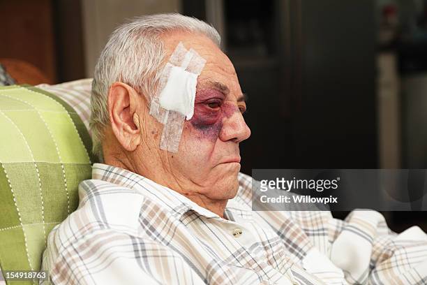 alter mann mit verletzten gesicht und black eye ist unzufrieden - head injury stock-fotos und bilder