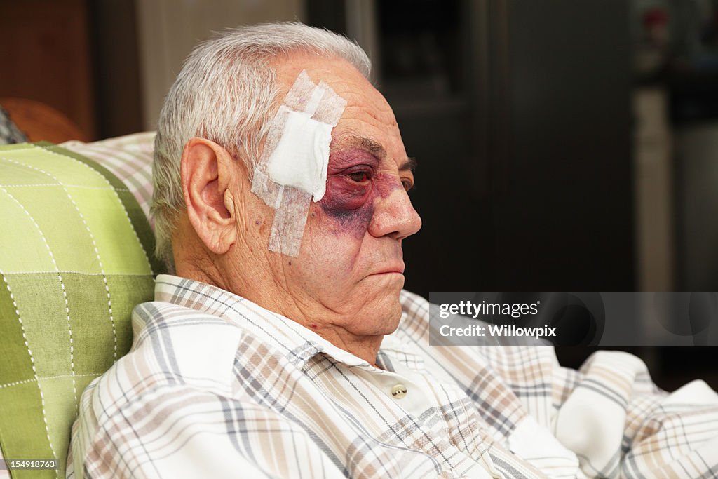 Senior Man With Injured Face and Black Eye is Unhappy