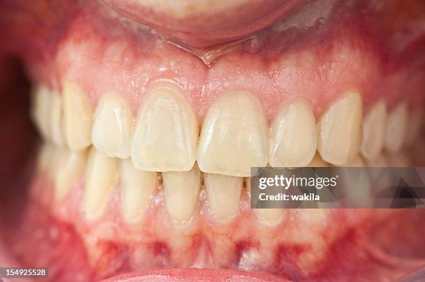 set of healthy human dentures - zähne mit zahnfleisch - rotten teeth from not brushing stockfoto's en -beelden