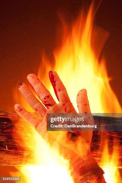fotos e imágenes de Quemadura Piel - Getty Images fotos e imágenes de Quemadura Piel - Getty Images