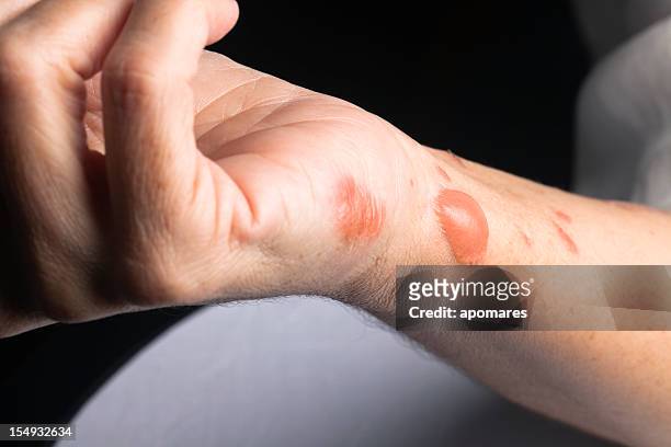 woman arm with actual second degree burn - blister stock pictures, royalty-free photos & images
