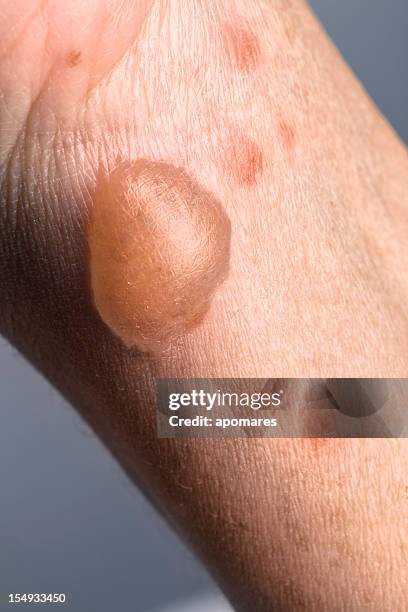 woman arm with actual second degree burn - burn blister stock pictures, royalty-free photos & images