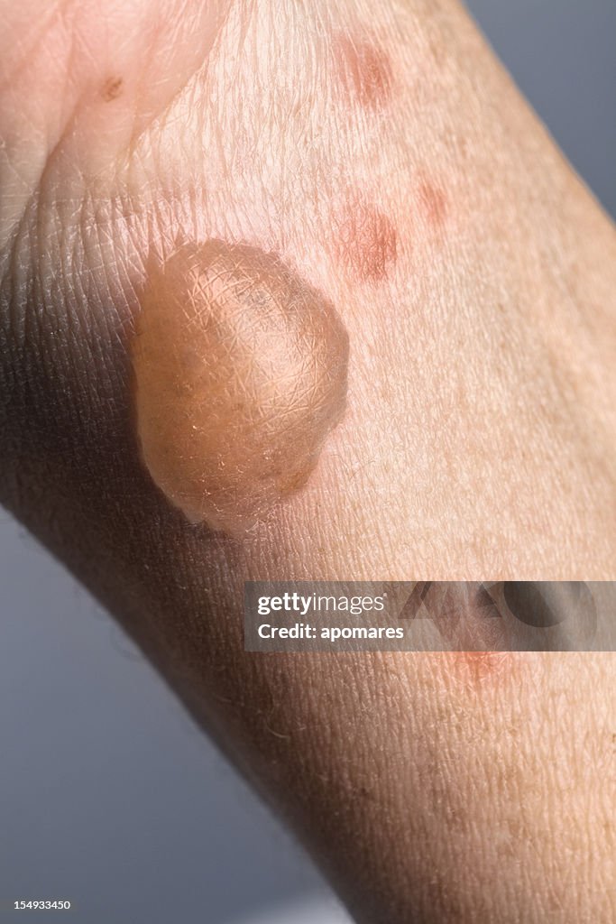 Woman arm with actual second degree burn