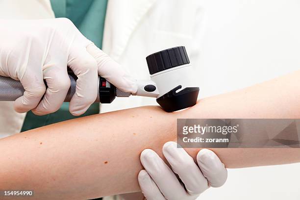 dermoscopy - cáncer de la piel fotografías e imágenes de stock