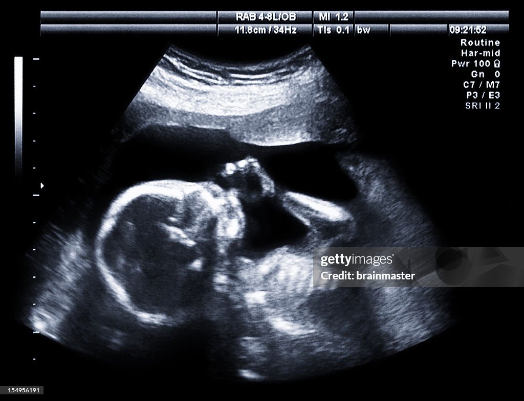 Ecografia bebé Chupar no Dedo Polegar