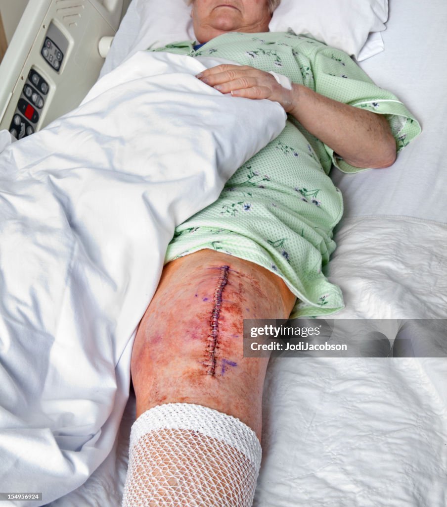 Artroplastia de la rodilla de incisión