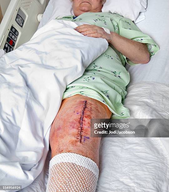 knee replacement incision - knee replacement surgery stock pictures, royalty-free photos & images