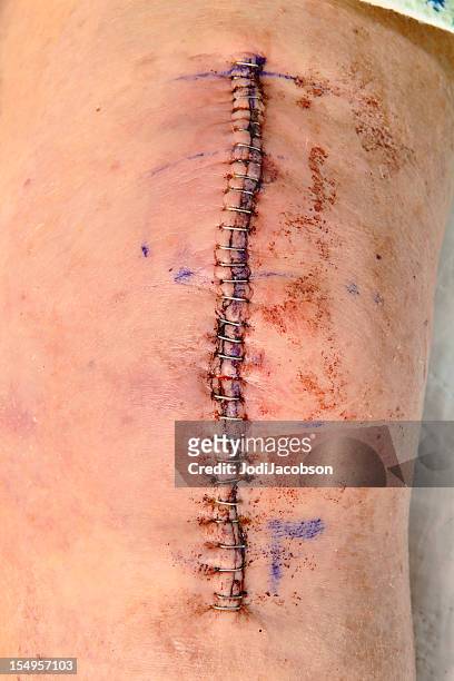 substituição incision joelho - knee replacement surgery - fotografias e filmes do acervo
