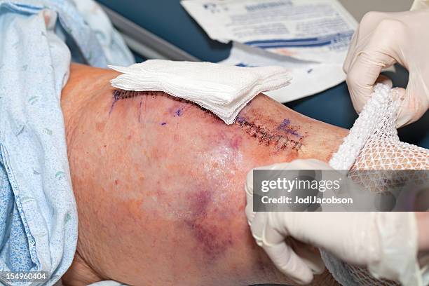 knee replacement bandage - knee replacement surgery stock pictures, royalty-free photos & images