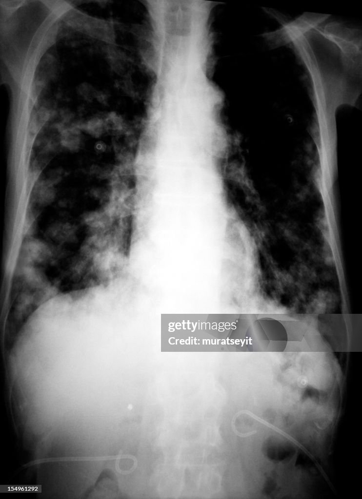Lung x-ray of a cancer patient
