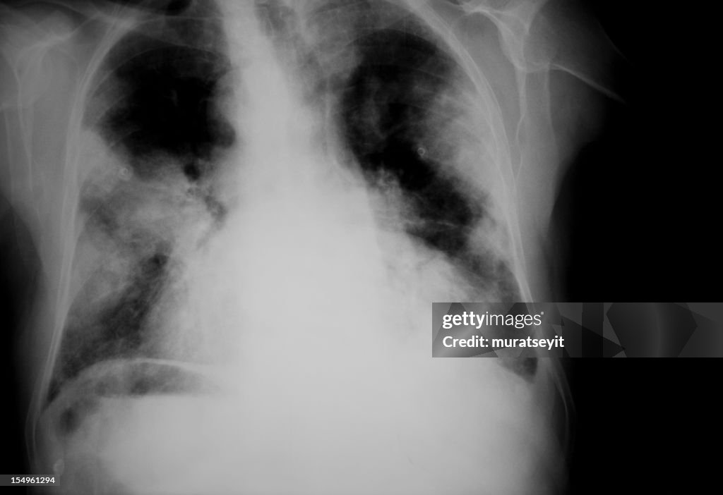 X-ray of a lunge Cancer