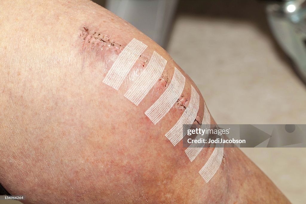 Knee replacement incision