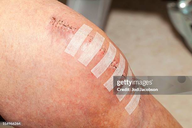 knee replacement incision - scar stock pictures, royalty-free photos & images