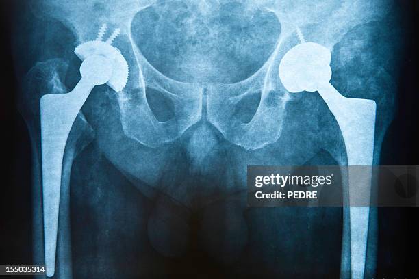 hip replacement - femur stock pictures, royalty-free photos & images