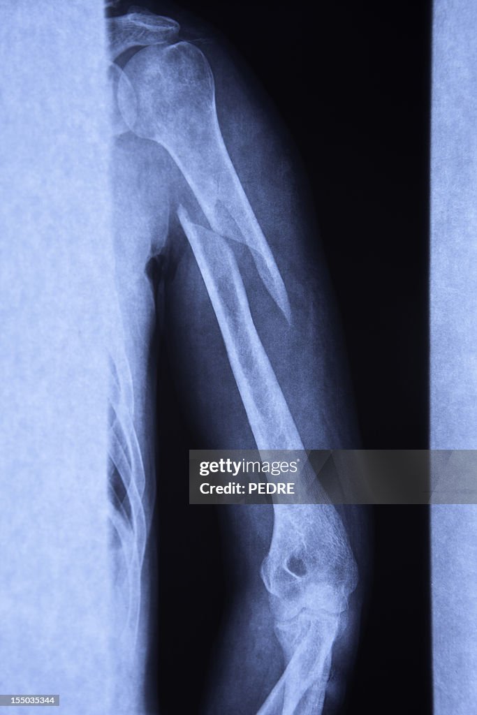 Broken arm